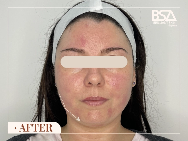 After HIFU Treatment 