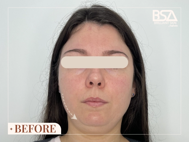 Before HIFU Treatment 