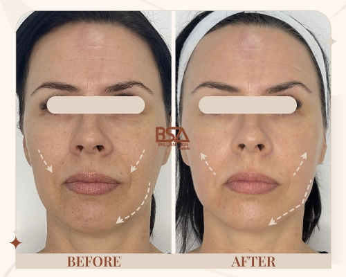 Before and after HIFU cheek lift showing improved facial contour and firmer skin at Brilliant Skin, Sydney.