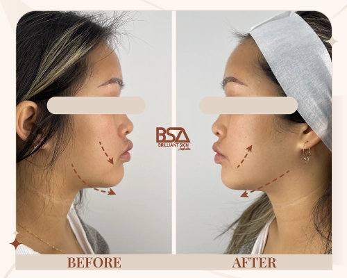 Front view before and after HIFU skin firming showing lifted cheeks and smoother skin texture at Brilliant Skin, Sydney.