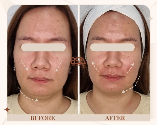 Side profile before and after HIFU neck lift showing firmer jawline and lifted skin at Brilliant Skin, Sydney.
