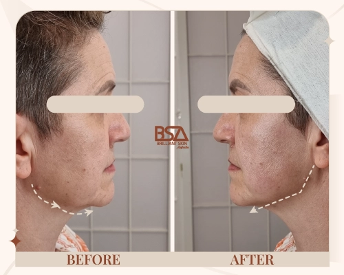 Before and after HIFU cheek tightening treatment showing lifted midface and smoother skin at Brilliant Skin, Sydney.