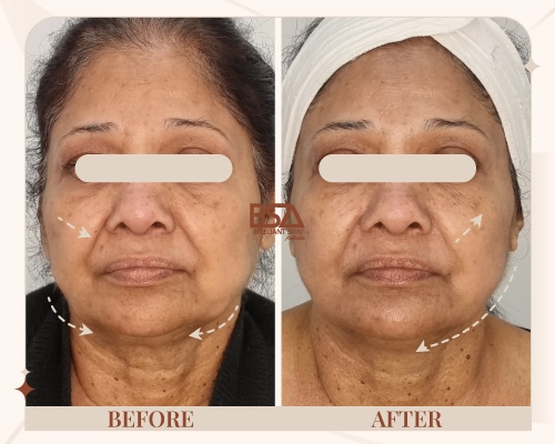 Before and after HIFU neck and jawline lift showing lifted lower face and defined contour at Brilliant Skin, Sydney.