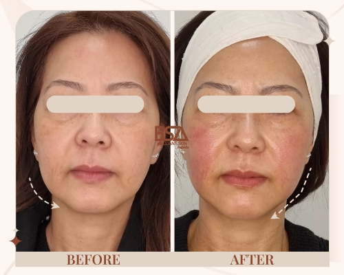 Before and after HIFU facial contouring showing balanced cheek lift and smoother jawline at Brilliant Skin, Sydney.
