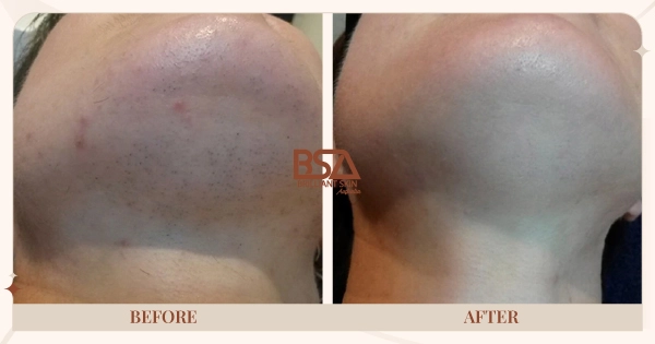 Before and After - Female chin hair removal before and after 6 IPL treatments