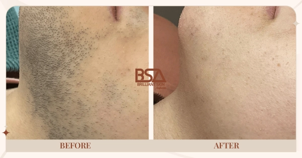 Before and After - Male chin hair removal before and after 6 IPL treatments