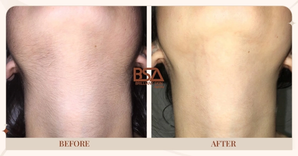 Before and After - Neck hair removal before and after 6 IPL treatments