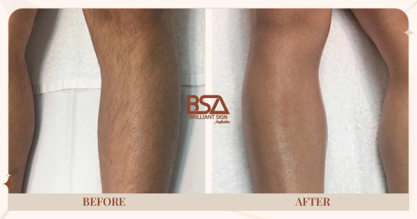 Before and After - Leg hair removal before and after 8 IPL treatments