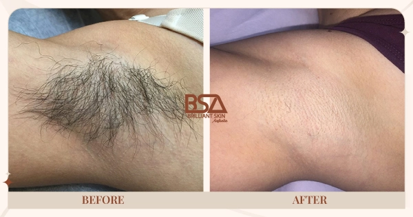 Before and After - Underarm hair removal before and after 5 IPL treatments