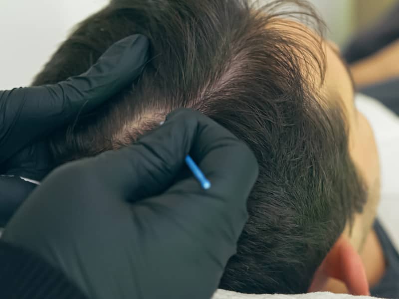 Scalp Micropigmentation