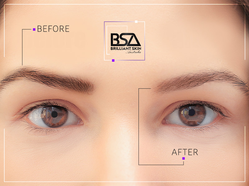 microblading removal permanent makeup removal  Microblading By  AngelaRegistered Nurse specializing in creating enhancing and  replicating hyperrealistic results