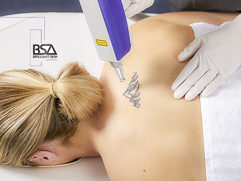 4 Reasons to Consider Laser Treatments for Removing Unwanted Tattoos  Laser  NY