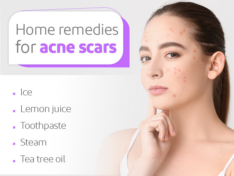 Home Remedies for Acne Scars