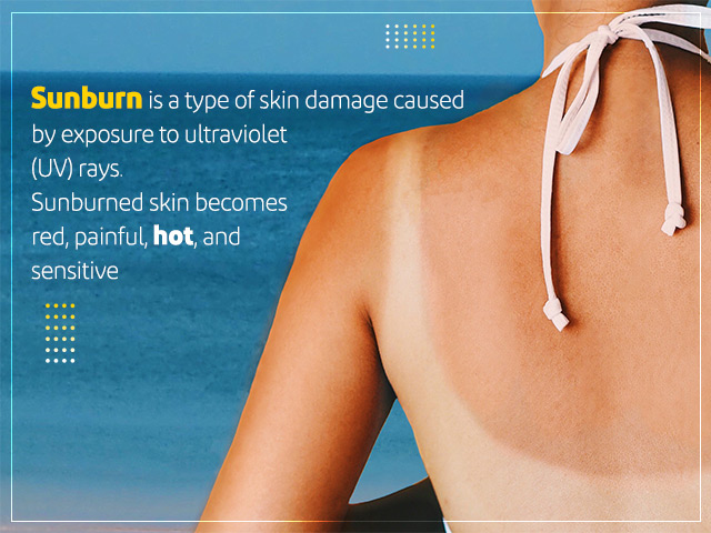 Instant Relief & Home Remedies for Sunburn