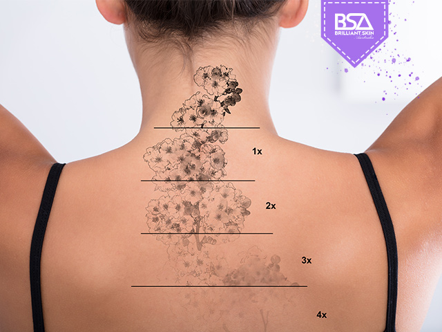 Laser Tattoo Removal Pain Scale