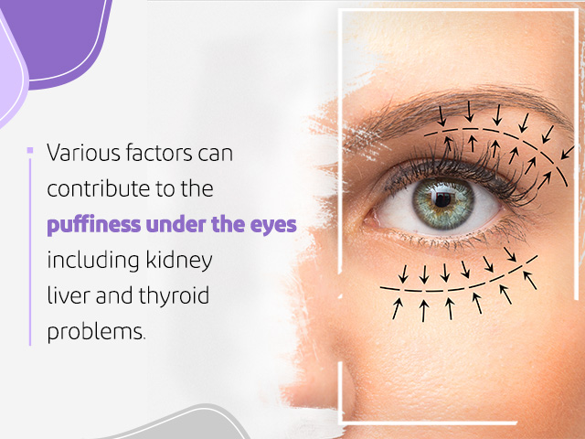 What Causes Puffy Eyes?