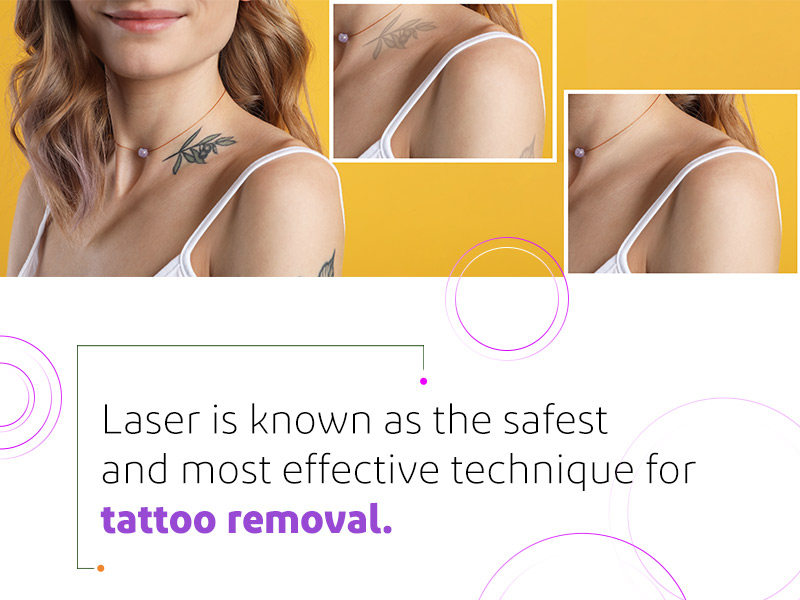 Is Laser Tattoo Removal Safe?