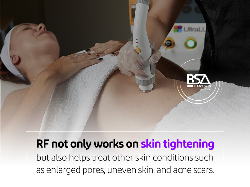 Radio frequency skin tightening