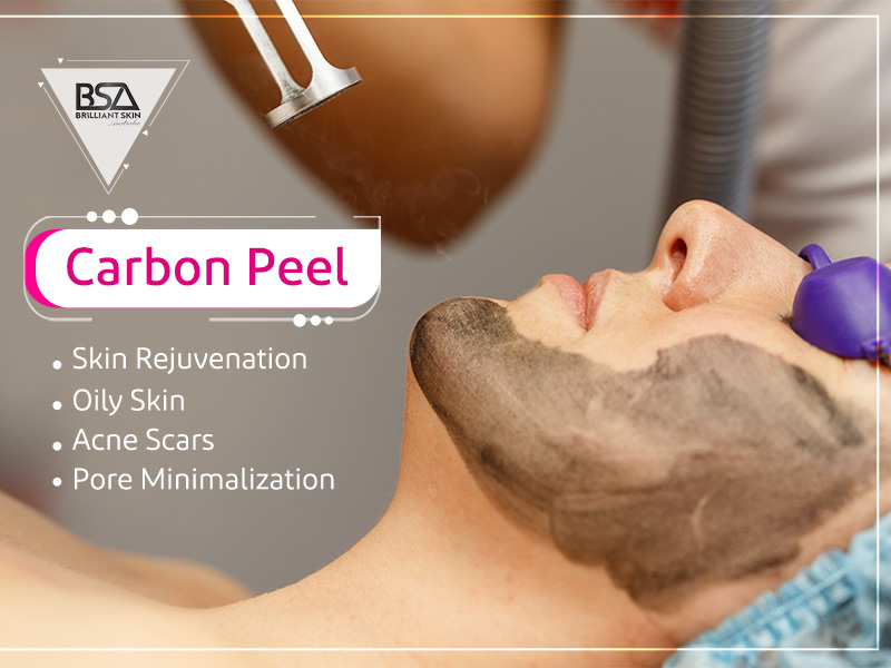 Carbon Peel