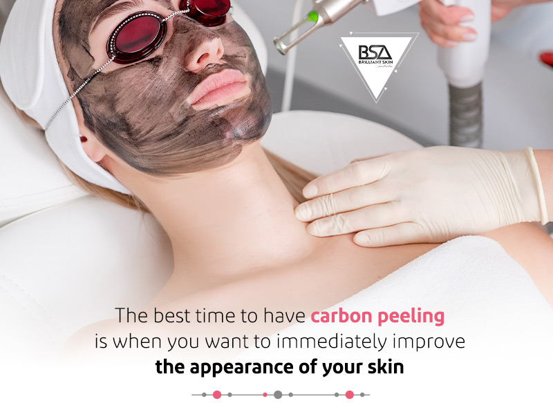 best time to have carbon peeling