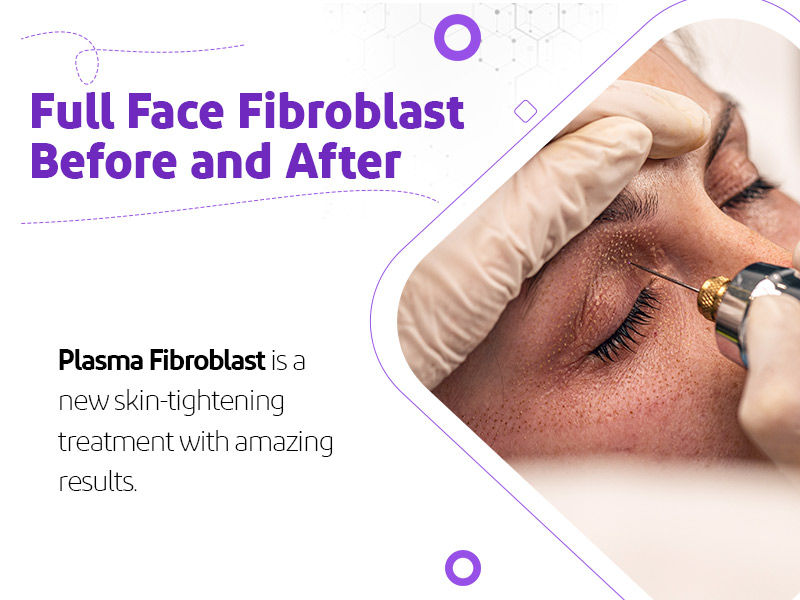 Full Face Fibroblast