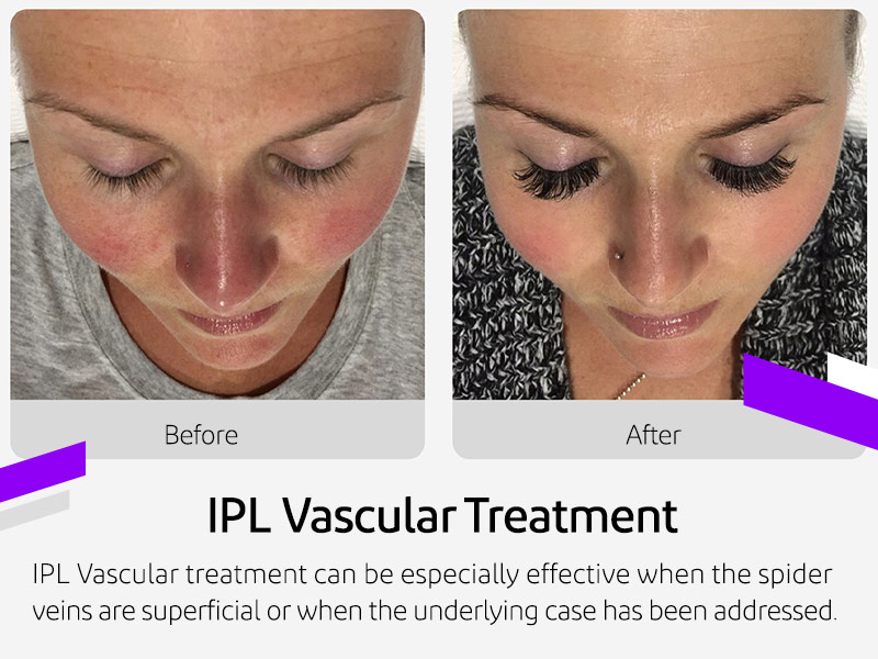 IPL Vascular Treatment