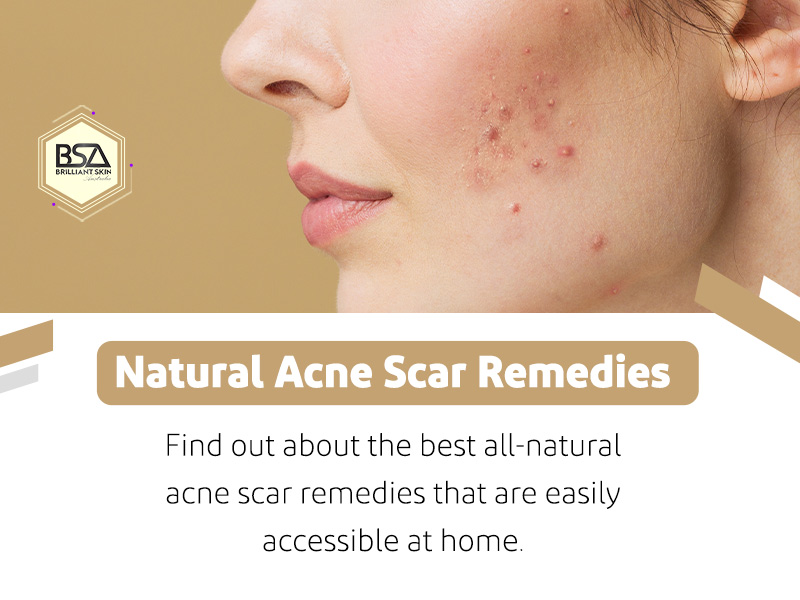 Natural Acne Scar Remedies