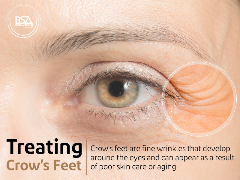 Treating Crow’s Feet 