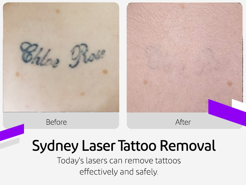 Sydney laser tattoo removal