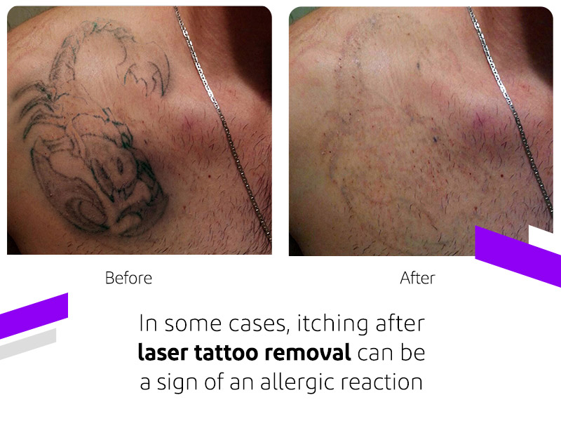 Laser Tattoo Removal Itching