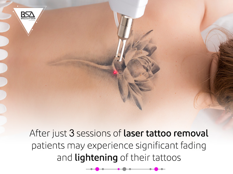 All Your Tattoo Removal Questions, Answered | RealSelf