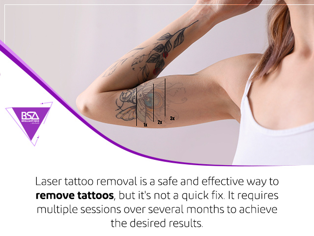 Laser Tattoo Removal | Metro Dermatology