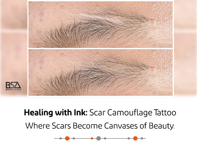 Scar Treatment By MicroArt Semi Permanent Scar Camouflage