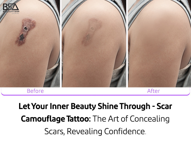 Glittering Health Beauty - SCAR CAMOUFLAGE ON BURNT SKIN : Also known as  cosmetic camouflage uses concealing products to help disguise scars,  birthmarks, unwanted tattoos and skin conditions including rosacea,  pigmentation and