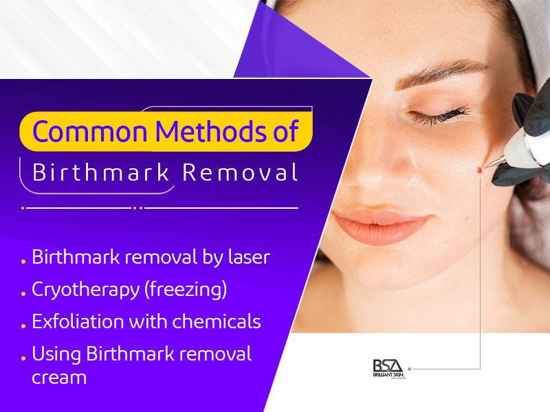 most common methods of birthmark removal