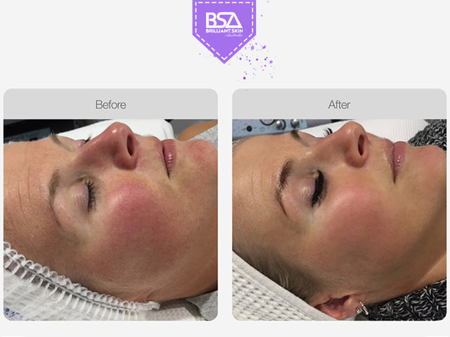 Before and After IPL Vascular Therapy