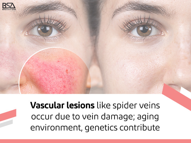 Vascular lesions