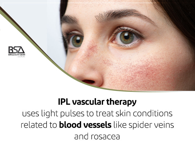IPL vascular therapy