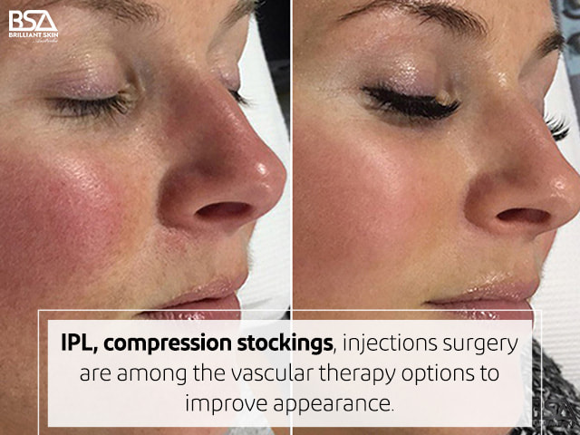 Vascular Lesions