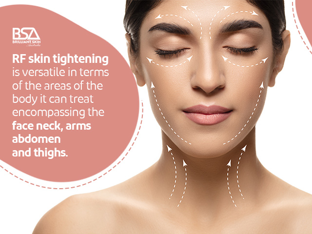 Benefits of RF Skin Tightening