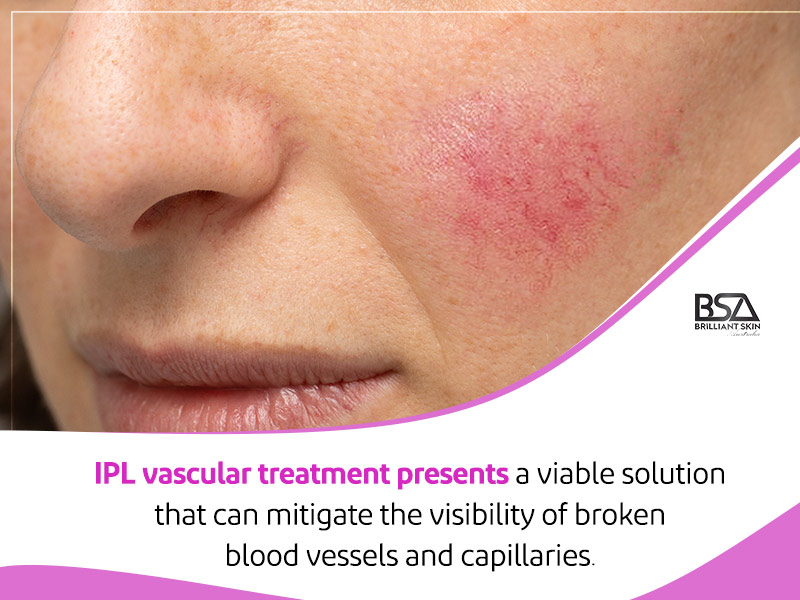 IPL Vascular Treatment for Broken Blood Vessels