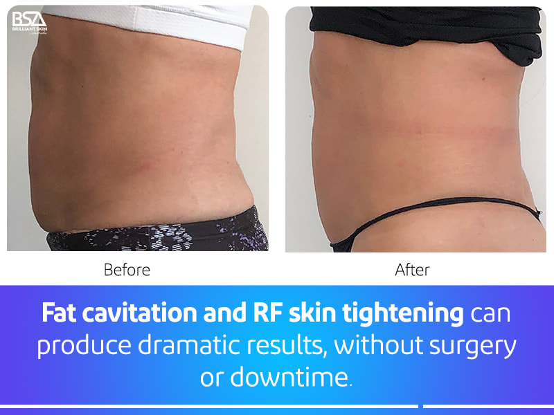 Ultrasound Cavitation Inch Loss - Skin Tech Clinic