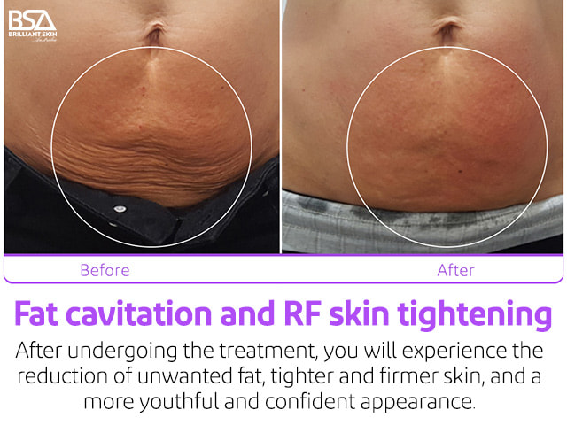 Fat cavitation and RF skin