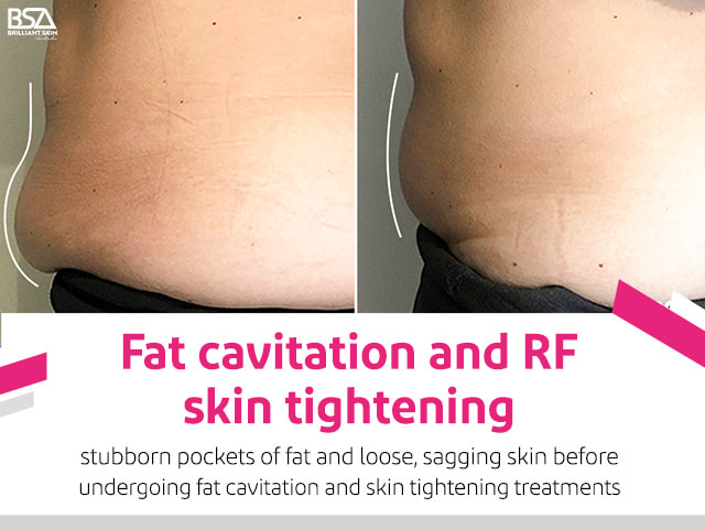 skin tightening