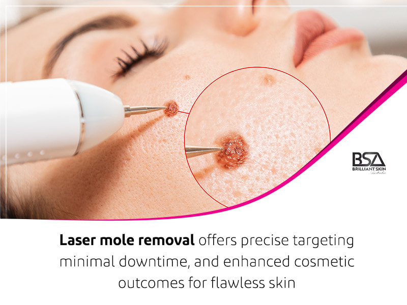 the best Laser mole removal