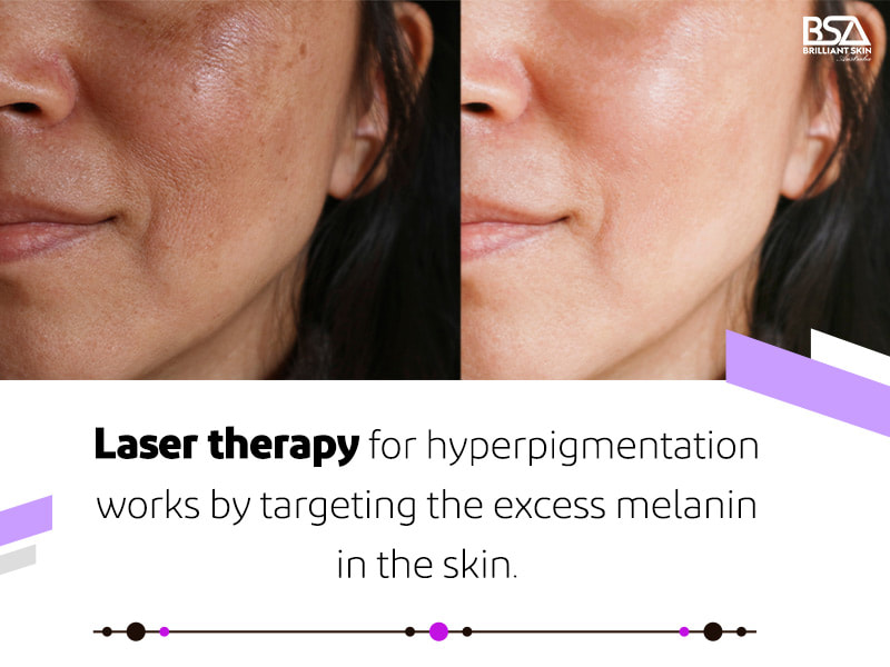 Laser treatment