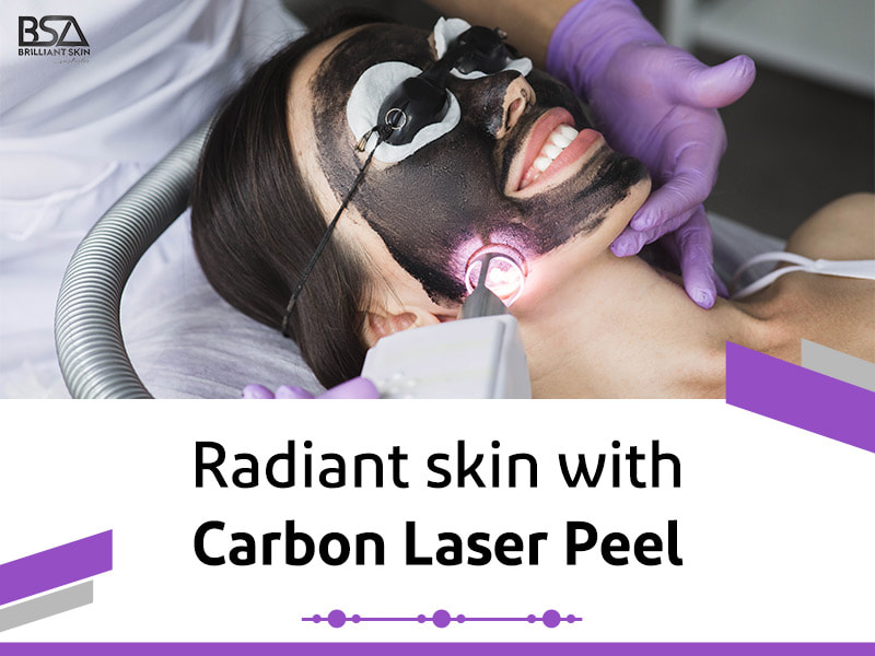 Carbon Laser Peel 