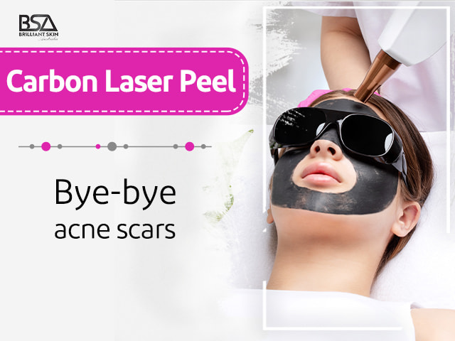 Remove acne with carbon laser