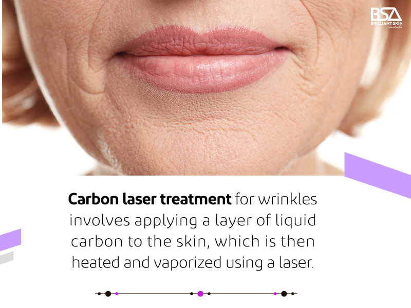 Carbon Laser Treatment