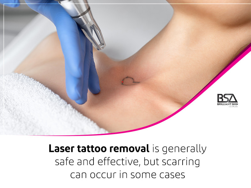 Laser Tattoo Removal 